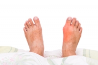 Possible Reasons Gout Attacks Can Occur