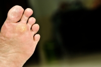 What Causes Plantar Warts?