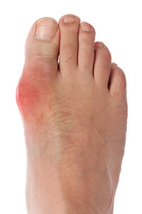 Gout and Kidney Diseases