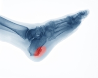 Conditions Associated with Heel Spurs