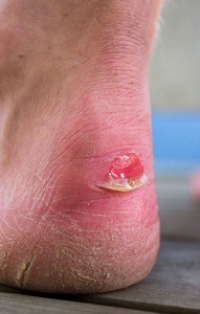 How to Prevent Blisters From Developing