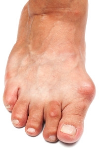 Bunions and Surgery