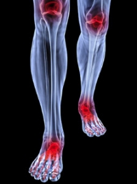 Do I Have Arthritis in My Feet?