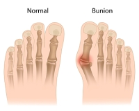 Overview of a Bunion