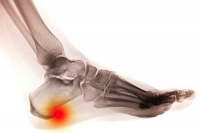Possible Symptoms of a Heel Spur