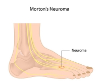 What Can Lead To Morton’s Neuroma?