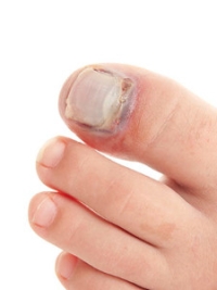 How Can I Tell If I’ve Broken My Toe?